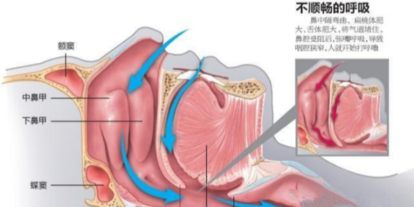 家用呼吸機是如何治療打鼾