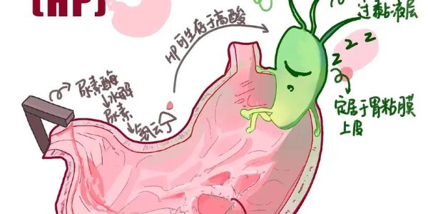 【必看】幽門螺桿菌真相揭示，別再忽視你的胃痛了！