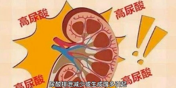 突然痛風？別再只怪啤酒和燒烤！真正的“尿酸元兇”遠比你想的多！